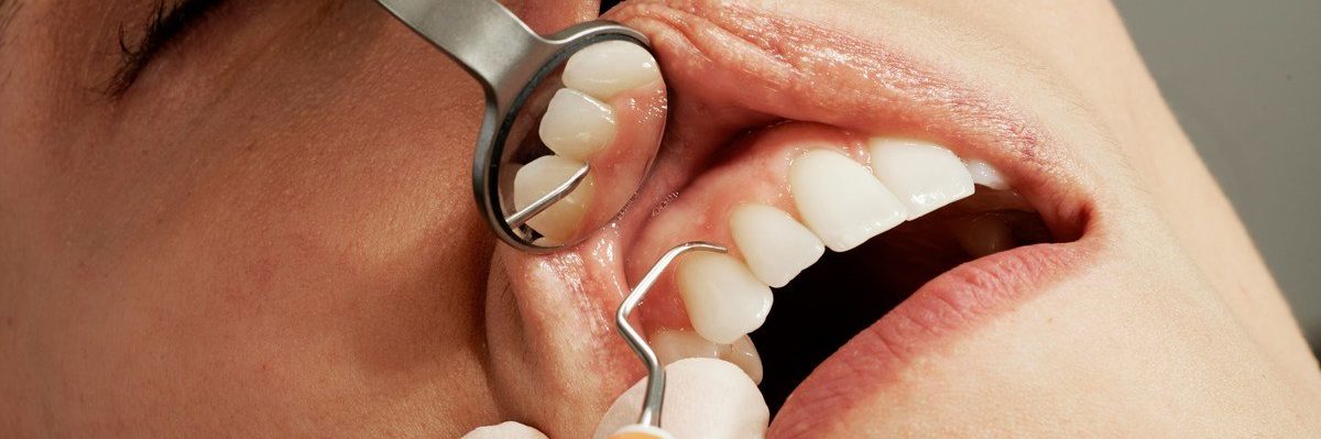 CZ eist vergoede tandartskosten terug, tienduizenden gedupeerden